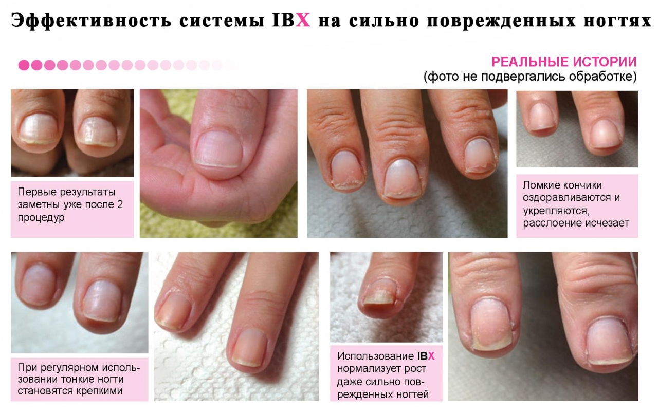 Эффективность системы IBX для лечения ногтей